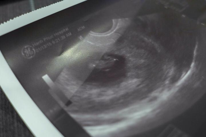 Nhờ lại lần đầu thấy hình siêu âm Silk mà mình mừng húm